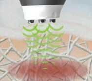 collagen & elastin regeneration with TriPollar Radiofrequnecy