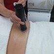 Acoustic Wave Therapy